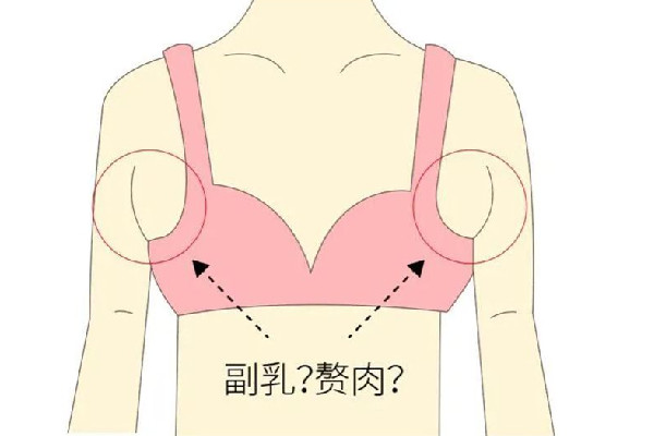 副乳切除手術會有疤痕嗎 副乳切除手術怎么才能看不到疤痕
