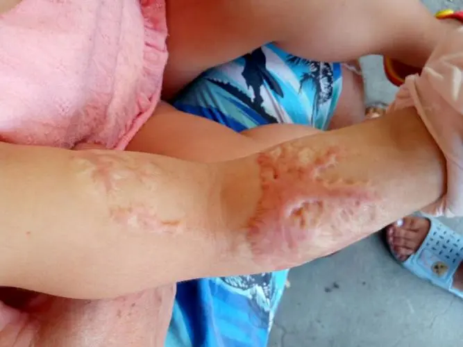 對于兒童疤痕，醫用疤痕凝膠和激光治療哪種更好？